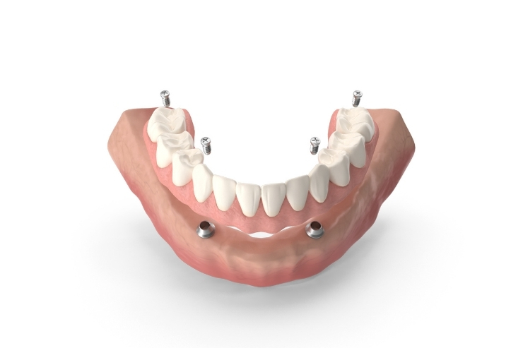 Hybrid Dentures Sreshta Dental, Dr. Pavan Preetham