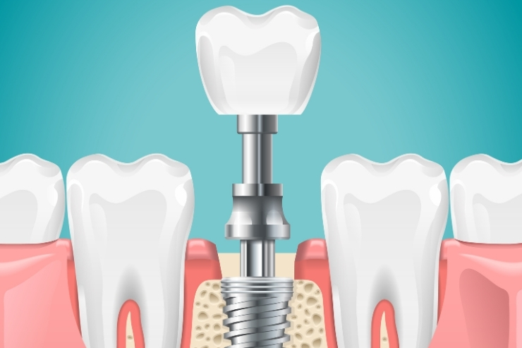 Dental Implants Sreshta Dental, Dr. Pavan Preetham